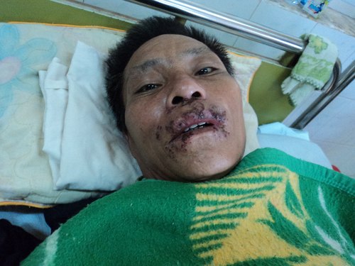 benh-nhan-dau-tien-bi-nhiem-lien-cau-lon